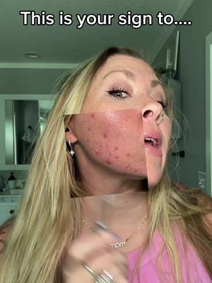 clear 3 Skin support supplement for acne