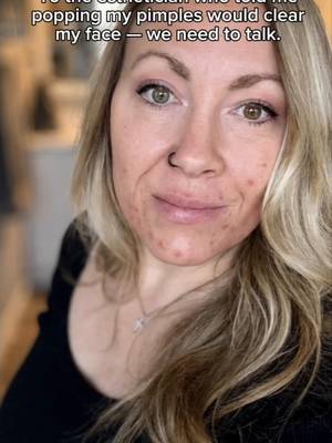 clear3 Hormonal acne skin support supplements
