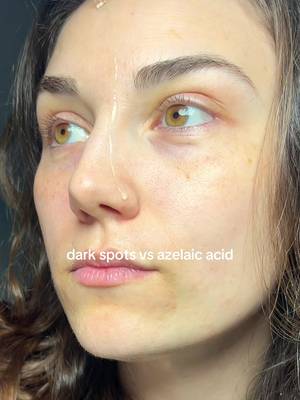 SKIN1004 Azelaic Acid 10 AmpouleSerum