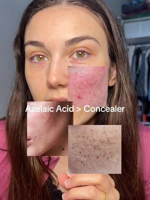 SKIN1004 Azelaic Acid 10 serum